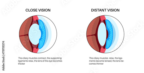 Eye accommodation poster