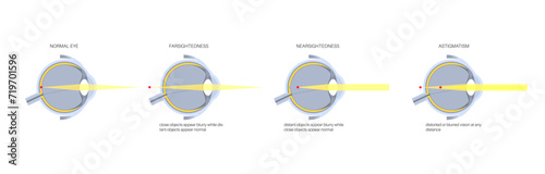 Refractive errors poster