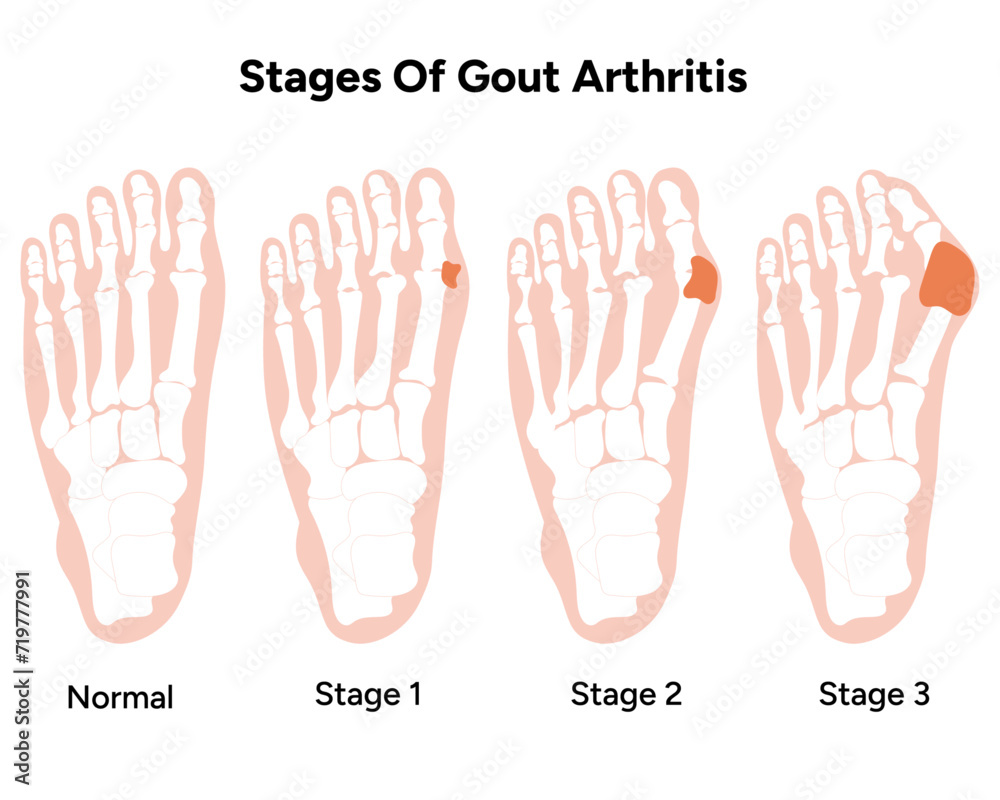 Obraz premium Stages of gout arthritis 