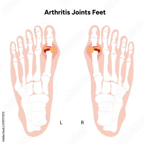 Arthritis joints feet