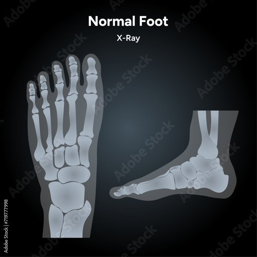 Normal foot x-ray 