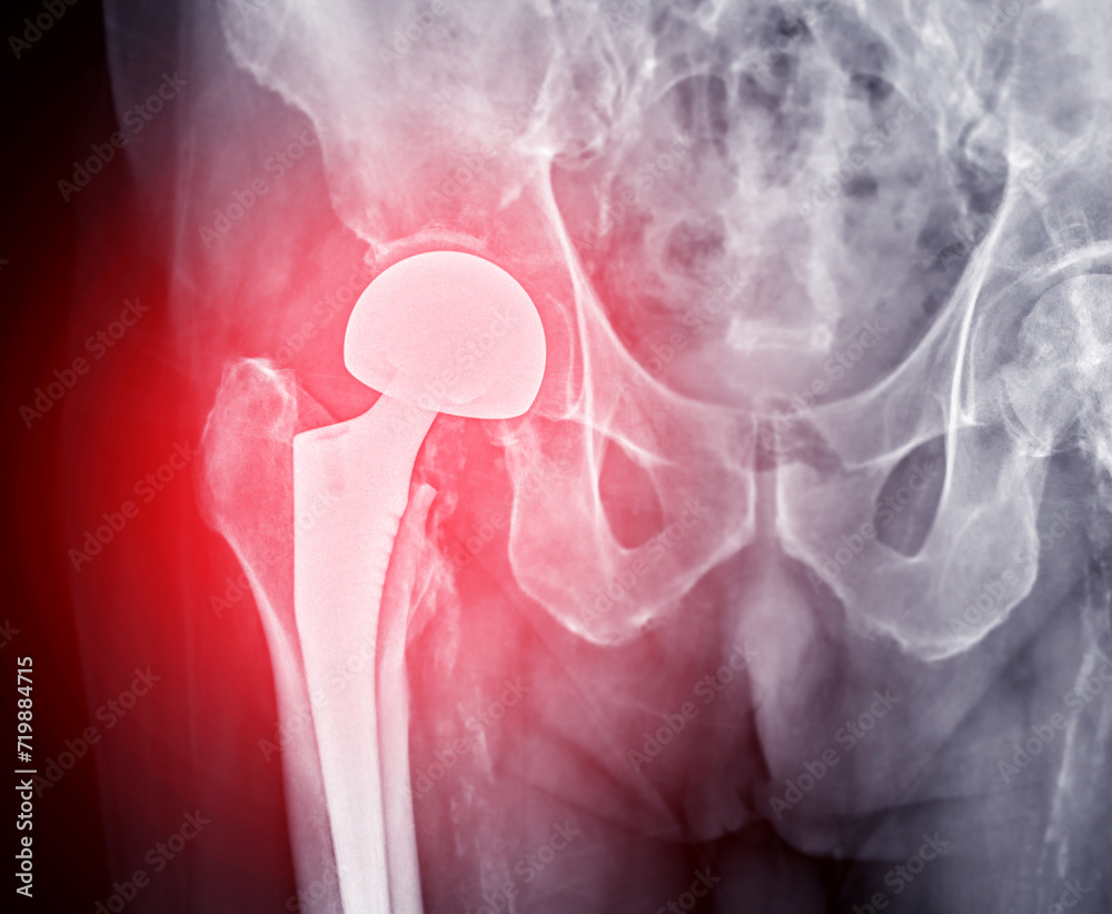 An Xray reveals both hip joints with TOTAL HIP ARTHROPLASTY