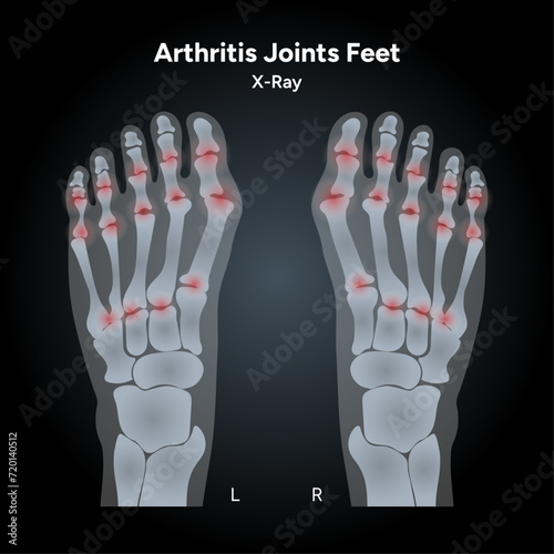 Arthritis rheumatoid joints feet pain in x-ray scan