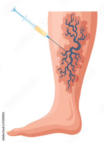 Stages or types of varicose veins development. Medical poster or disease infographic. Image of diseased legs. Vector illustration in flat style