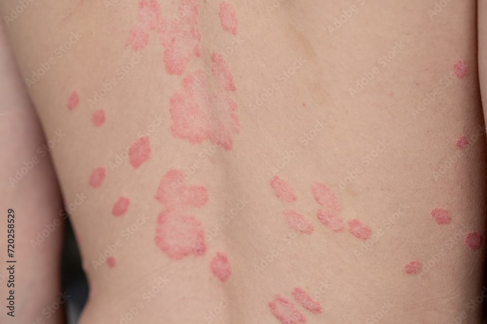 Psoriasis Vulgaris, skin patches are typically red, itchy, and scaly. Papules of chronic psoriasis vulgaris on male hand, back and body. Genetic immune disease. Detail of psoriatic skin disease Psoriasis Vulgaris, skin patches are typically red, itchy, and scaly. Papules of chronic psoriasis vulgaris on male hand, back and body. Genetic immune disease. Detail of psoriatic skin disease