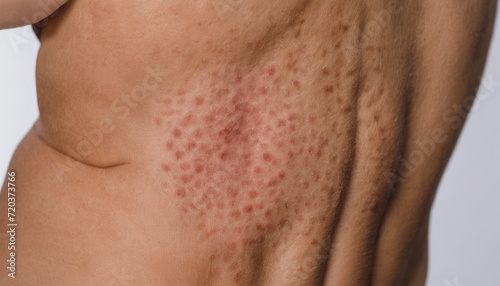 A close up of a man s back with acne