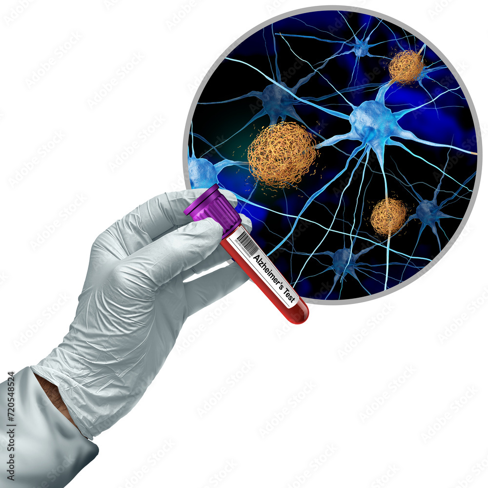 Alzheimers blood screening test diagnostics and alzheimer dementia