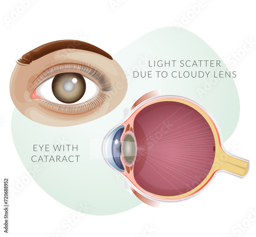Human Eye with Cataract - Cloudy Lens - Illustration