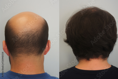 Before and after of man gets hair transplant, Hair growth, solution treatment for hair fall