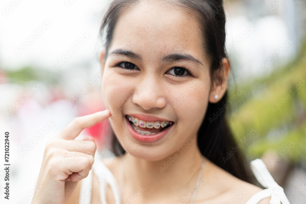 Young female beautiful smile with braces. Close up beautifying teeth. Oral hygiene, cleanliness. Happy girl in good mood smile showing teeth . Young female beautiful smile with braces. Close up beautifying teeth. Oral hygiene, cleanliness. Happy girl in good mood smile showing teeth .