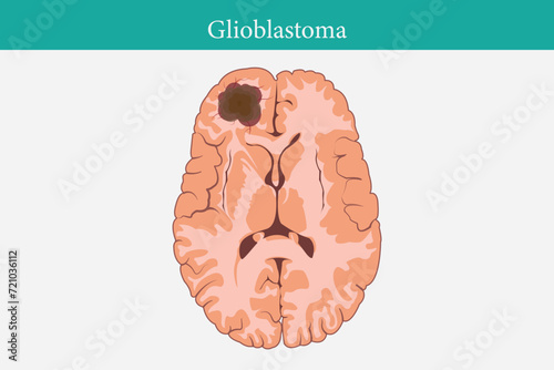 Brain cancer concept. Malignant tumor develops in the human brain. Cancer cell structure. Flat vector illustration. eps 10