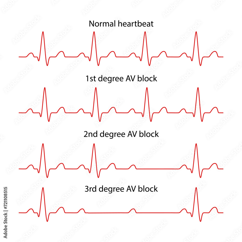 Diagram of normal rhythm and AV block for a human heart. Heart cardiogram. Vector illustration in flat style isolated on white background