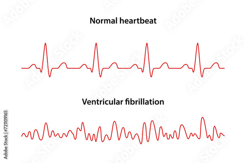 Diagram of normal rhythm and Ventricular fibrillation for a human heart. Heart cardiogram. Vector illustration in flat style isolated on white background