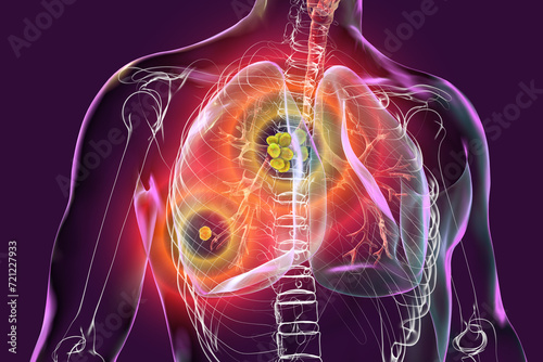 Primary lung tuberculosis, 3D illustration photo