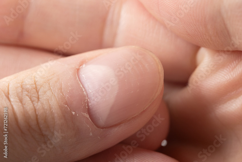 Ridged fingernails with vertical and horizontal ridges. Nails problems.