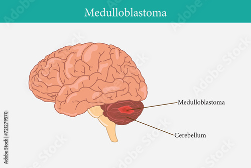 Human anatomy disease. medulloblastoma vector illustration on white background. eps 10