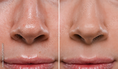 Blackhead treatment  before and after. Collage with photos of woman  closeup view