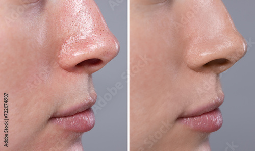 Blackhead treatment, before and after. Collage with photos of woman on grey background, closeup view photo