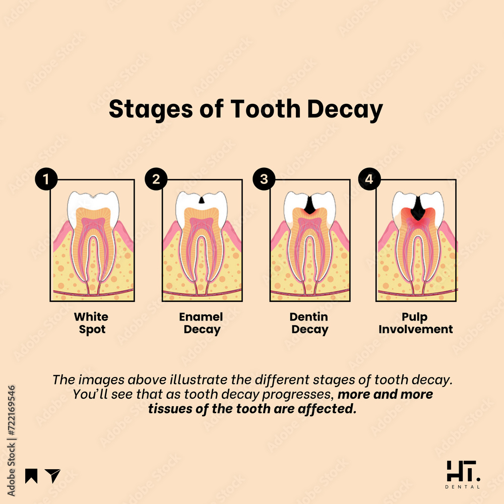 Stages of Tooth Decay Stock Illustration | Adobe Stock