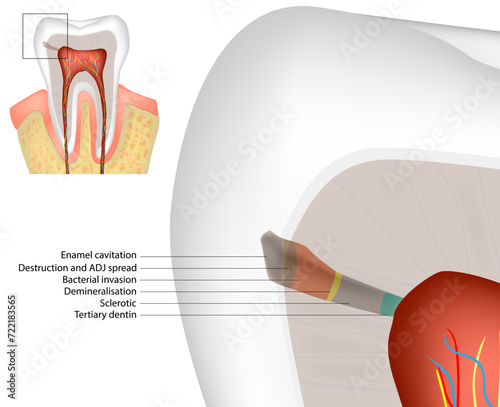 Histopathology of Caries in Enamel and Dentine. Enamel Dentin Pulp complex. Diagram Dental Caries. Tertiary dentine