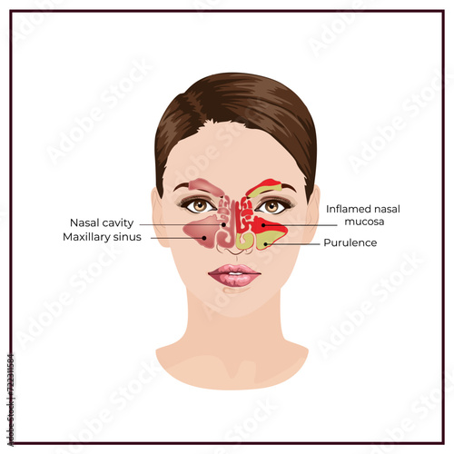 Anatomical illustration of the maxillary sinus. Diagnosis of maxillary sinusitis. Anatomical illustration for patients, physicians and students of medical colleges and universities. Vector 