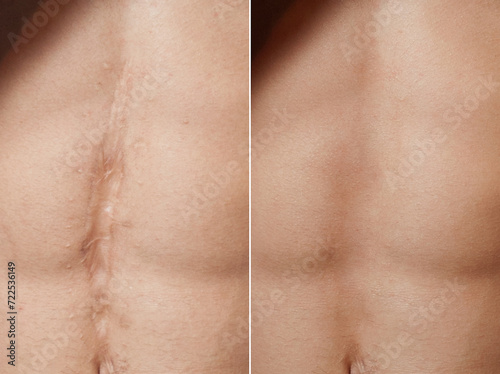 Laser scar removal before and after photo