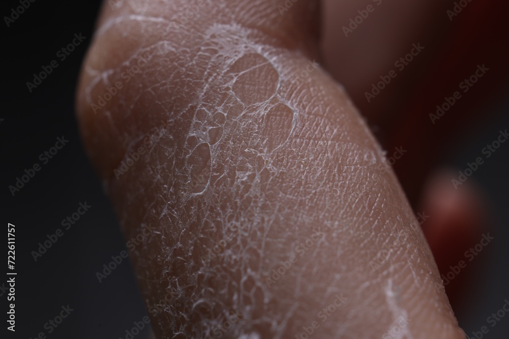 Fototapeta premium Woman with dry skin on hand, macro view