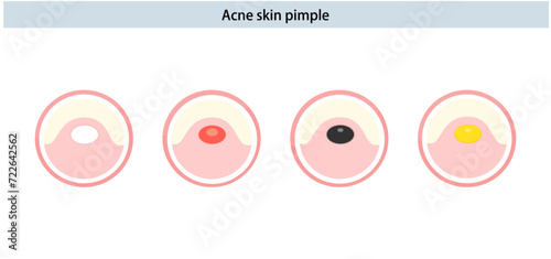 Acne skin pimple