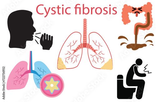 Cystic fibrosis,recurring chest infections,wet-sounding coughs,
diarrhoea,occasional wheezing and shortness of breath,Medical illustration of symptoms of cystic fibrosis, five