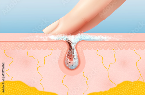 Skin pore cleaning realistic 3d vector cross-section view reveals finger removes debris and excess oil with foam, showcasing a cleansed epidermal layer for a refreshed and revitalized complexion