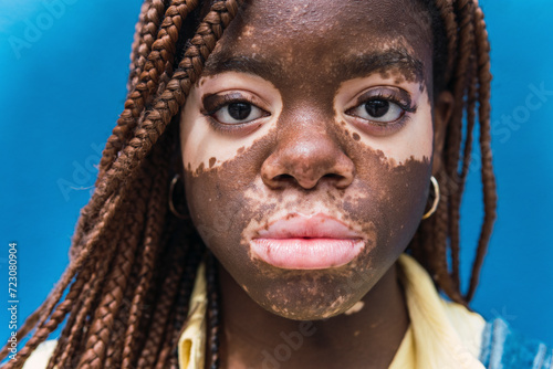 Young woman with depigmentation on face against blue background photo