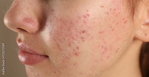 Teenage girl with acne problem on beige background, closeup photo