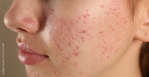 Bild auf Leinwand Teenage girl with acne problem on beige background, closeup