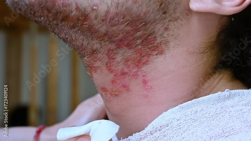 Slow motion footage with a portrait of the face of a young Caucasian man suffering from seborrheic dermatitis: a cotton pad is rubbed with micellar water to clean the skin. Skin and body care. photo