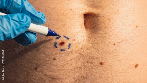 Preparing procedure for medical skin surgery. Unrecognizable Doctor in medical gloves paint lines around male birthmarks. Laser skin tags removal. Prevention of melanoma and nevus exam photo