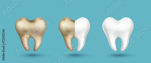 Realistic tooth before and after cleaning procedure at dentist - dirty gray and yellow with stains and clean white shiny. Vector set of bad and healthy teeth for dental care and hygiene design.
