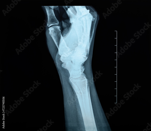 Lunate dislocation X-ray of the side of a woman`s hand and wrist uncommon traumatic wrist injury photo