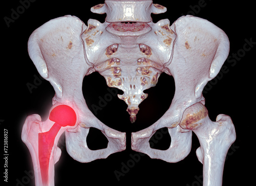 An X-ray reveals both hip joints with TOTAL HIP ARTHROPLASTY, showcasing the success of the surgical procedure and providing a visual testament to the restored mobility and function. photo