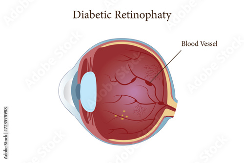 illustration of diabetic retinopathy in human eyes. eps 10