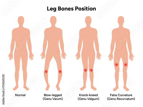 Leg bones position Blowlegged knock-kneed face curvature