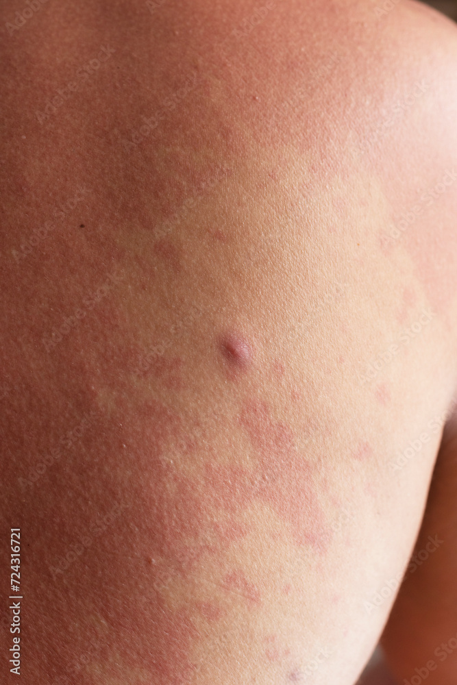 Human skin, presenting an allergic reaction, allergic rash. - obrazy, fototapety, plakaty 