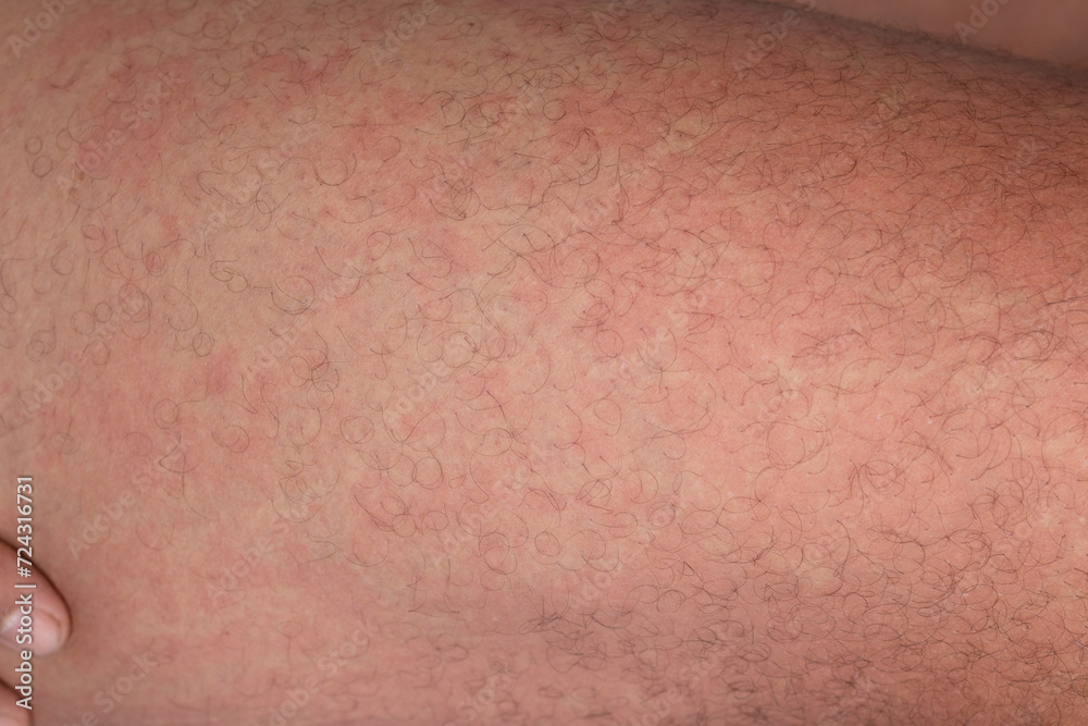 vesicular rash reaction from drug allergy