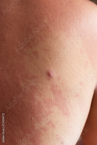 Human skin, presenting an allergic reaction, allergic rash.