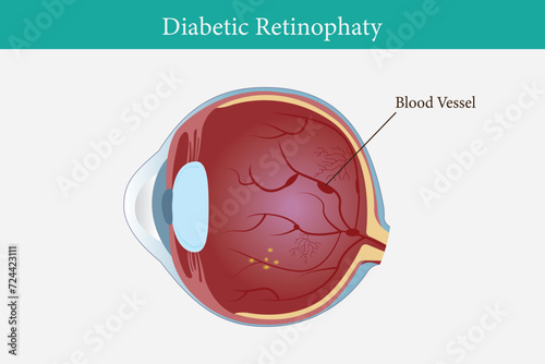 illustration of diabetic retinopathy in human eyes. eye vision disorder. eps 10