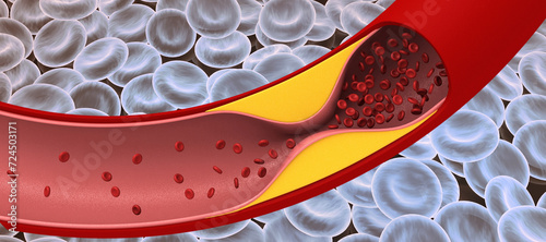 фотографія Cholesterol in blood vessels. 3d illustration..