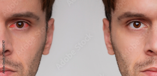 Close up portrait of man with red eye before and after treatment or eye drop. Tired eyes and contact lenses. Dry eye, depression, sick, virus, sleepy..
