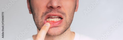 Close up image of gum inflammation. Cropped shot of a young man showing red bleeding gums isolated on a gray background. Dentistry, dental care.