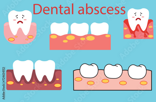 Dental abscess,dental nerve removal, The barbed broach is used to remove the majority of tissue from inside a tooth, caries development. Dental disease: caries,five