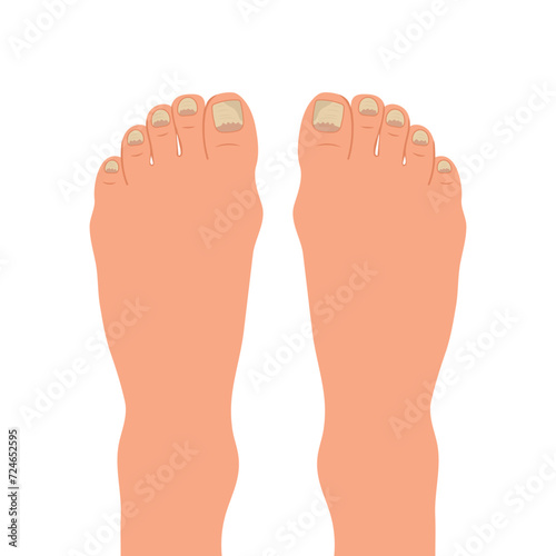 Swollen toe, onychocryptosis. Foot with nail disease or infection. Foot with onychomycosis or nail fungus. Healthcare and medicine. Vector
