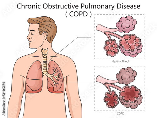 Chronic obstructive pulmonary disease COPD diagram hand drawn schematic vector illustration. Medical science educational illustration